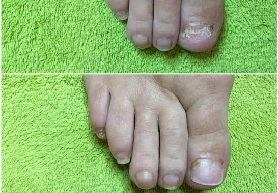 Nagelprothetik Nagelprothetik