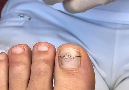 Nagelkorrekturspange Nagelkorrekturspange